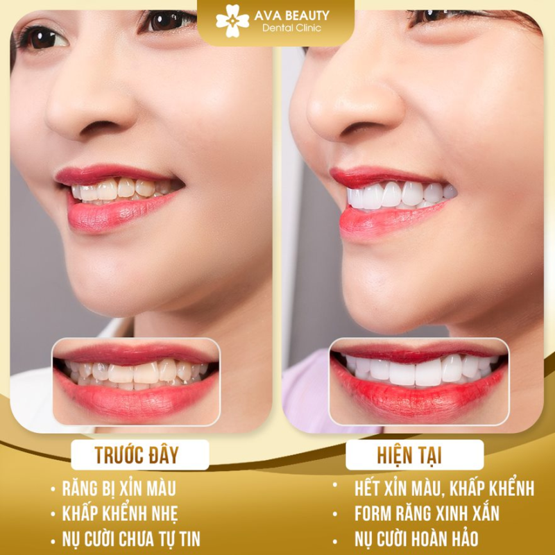 Bọc răng sứ - AVA Dental